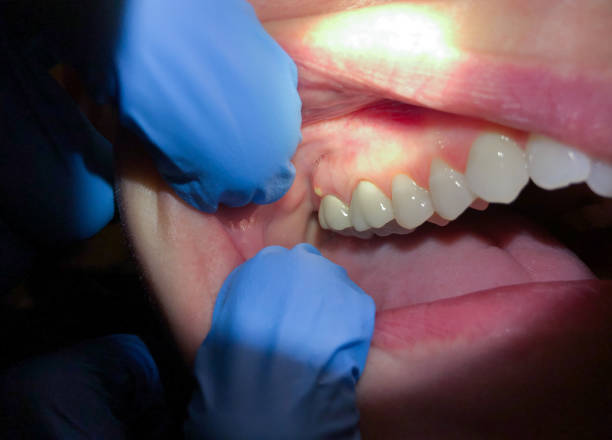 Best Emergency Root Canal Treatment in Mound Bayou, MS
